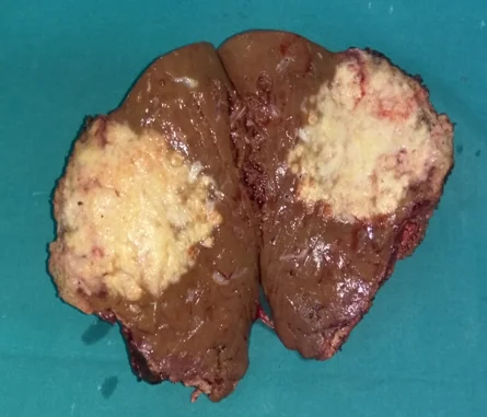 TRI-SEGMENTECTOMY RIGHT HEPATIC LOBE