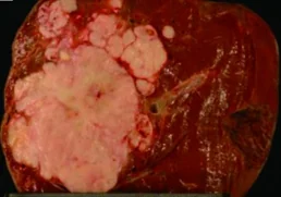 TRI-SEGMENTECTOMY CROSS SECTION