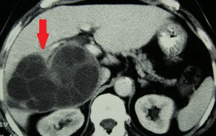 HYDATID LIVER CYST