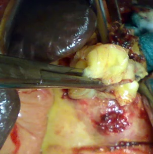 HYDATID CYST EVACUATION