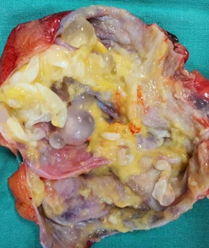 HYDATID HEPATIC CYST