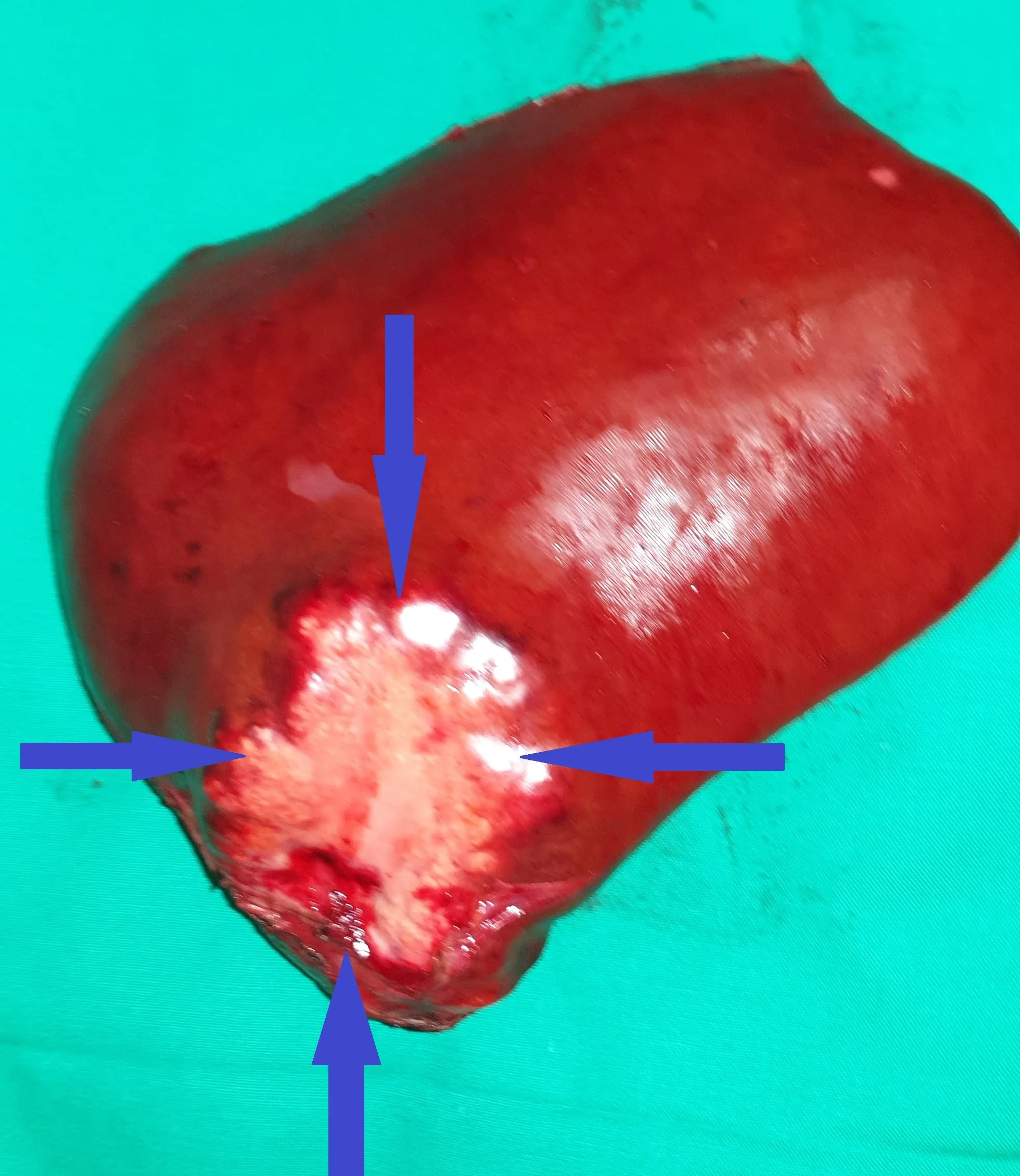 METASTATIC LESION RIGHT HEPATIC LOBE