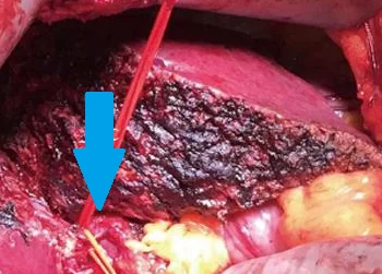 PRESERVATION OF INFERIOR HEPATIC VEINS