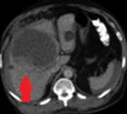 BLEEDING SIMPLE HEPATIC CYST