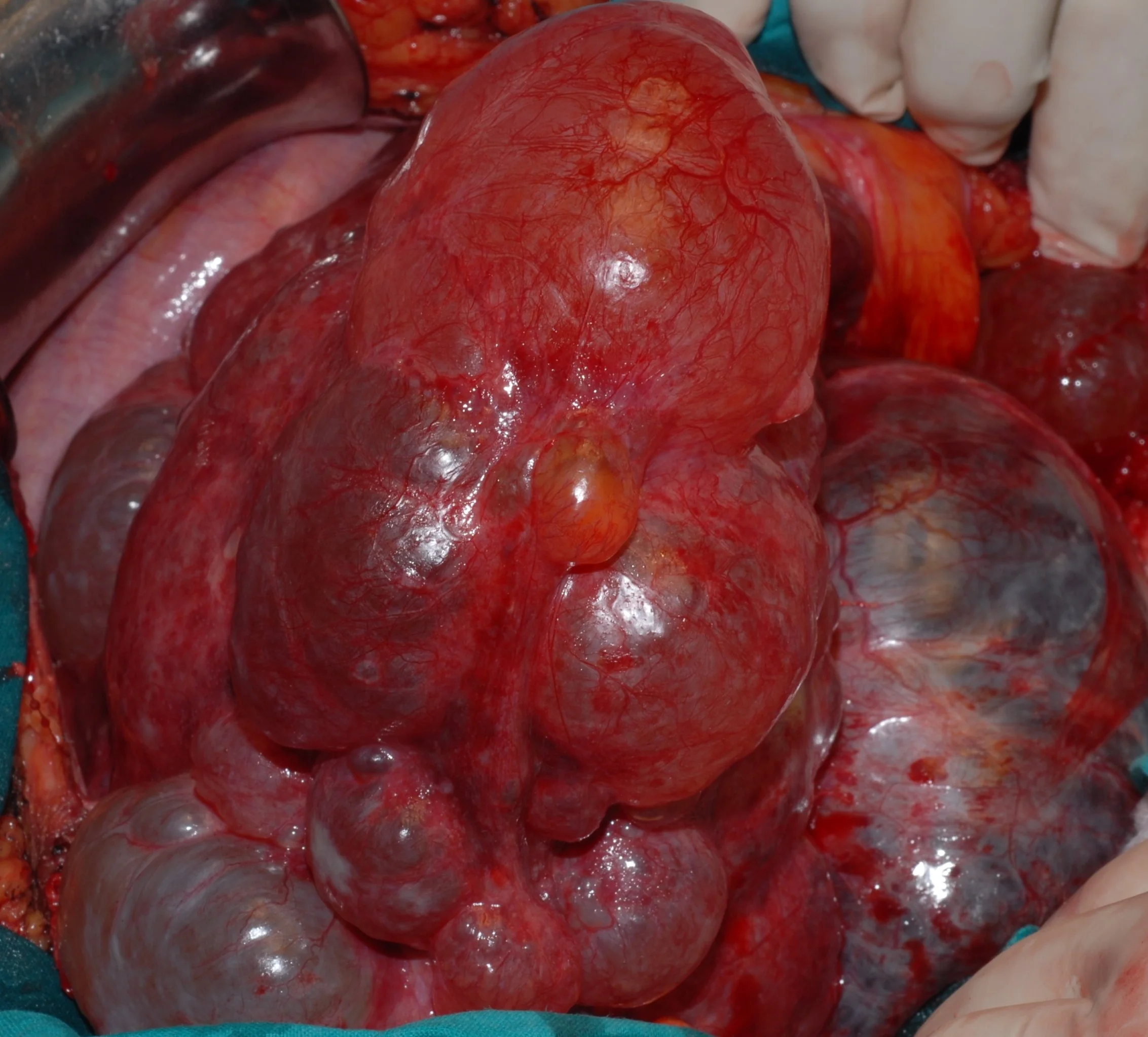 LIVER CYSTIC DISEASE