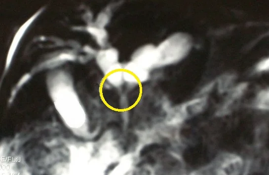PORTAL BILIARY DUCTOPATHY