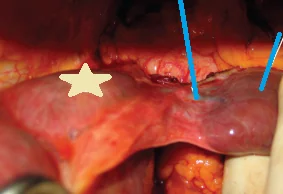 ACCESSORY HEPATIC LOBE TORSION
