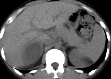 AMOEBIC LIVER ABSCESS