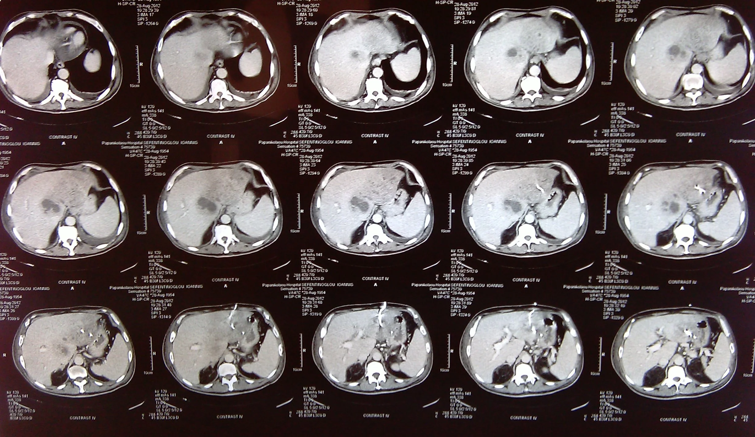 MULTIPLE LIVER ABSCESSES