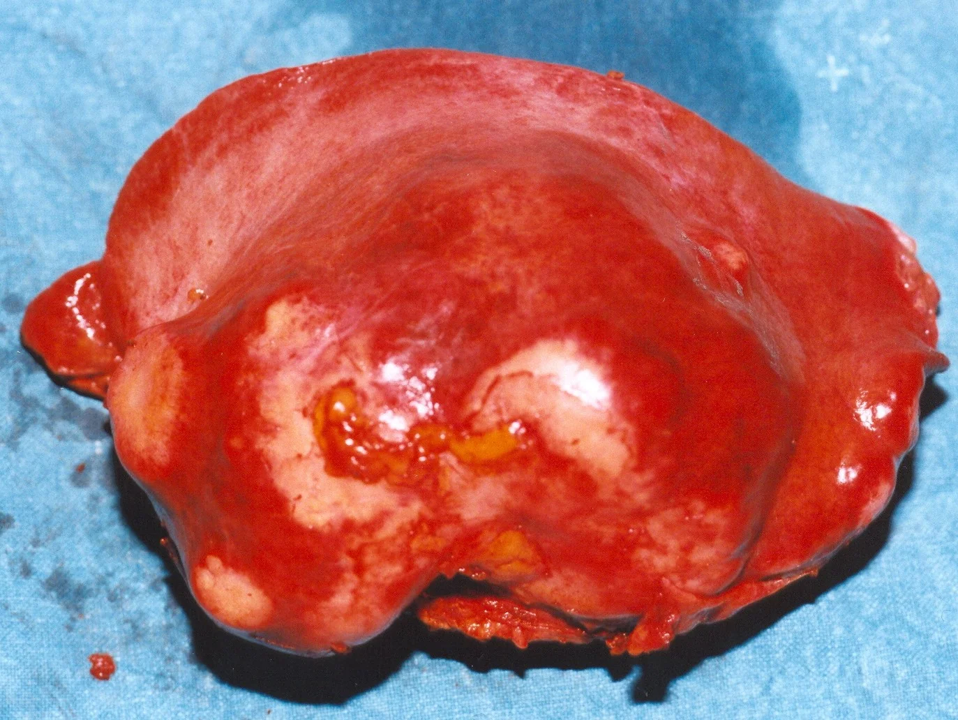 LEFT LIVER LOBECTOMY