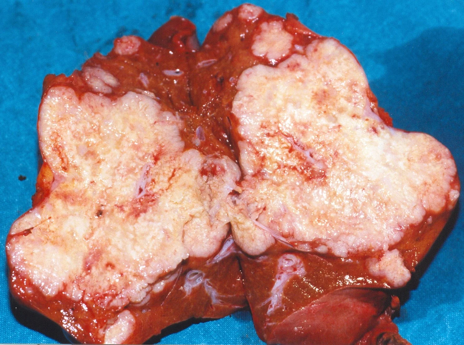 LEFT LIVER LOBECTOMY