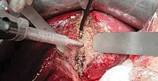 CUSA DISSECTING SEALER
