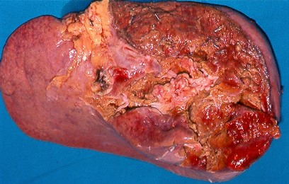 LEFT HEPATIC LOBECTOMH 