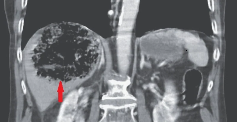 EMPHYSEMATOUS HEPATITIS