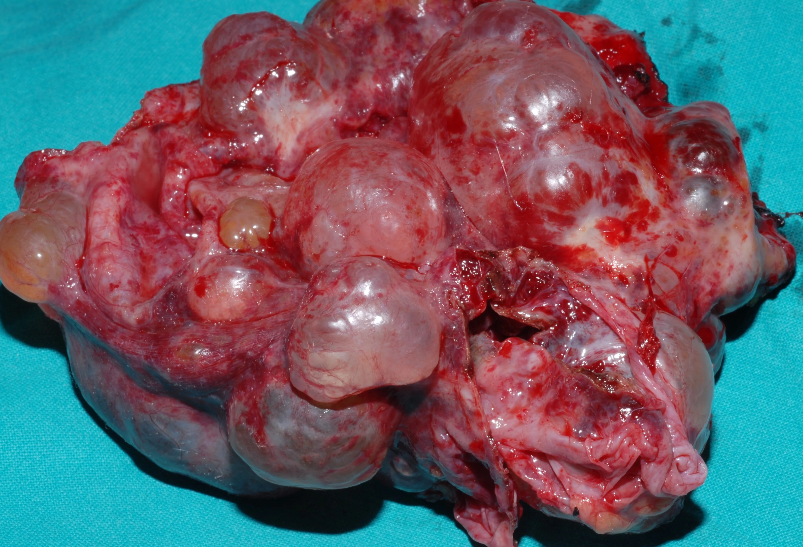 INFECTED LIVER CYST