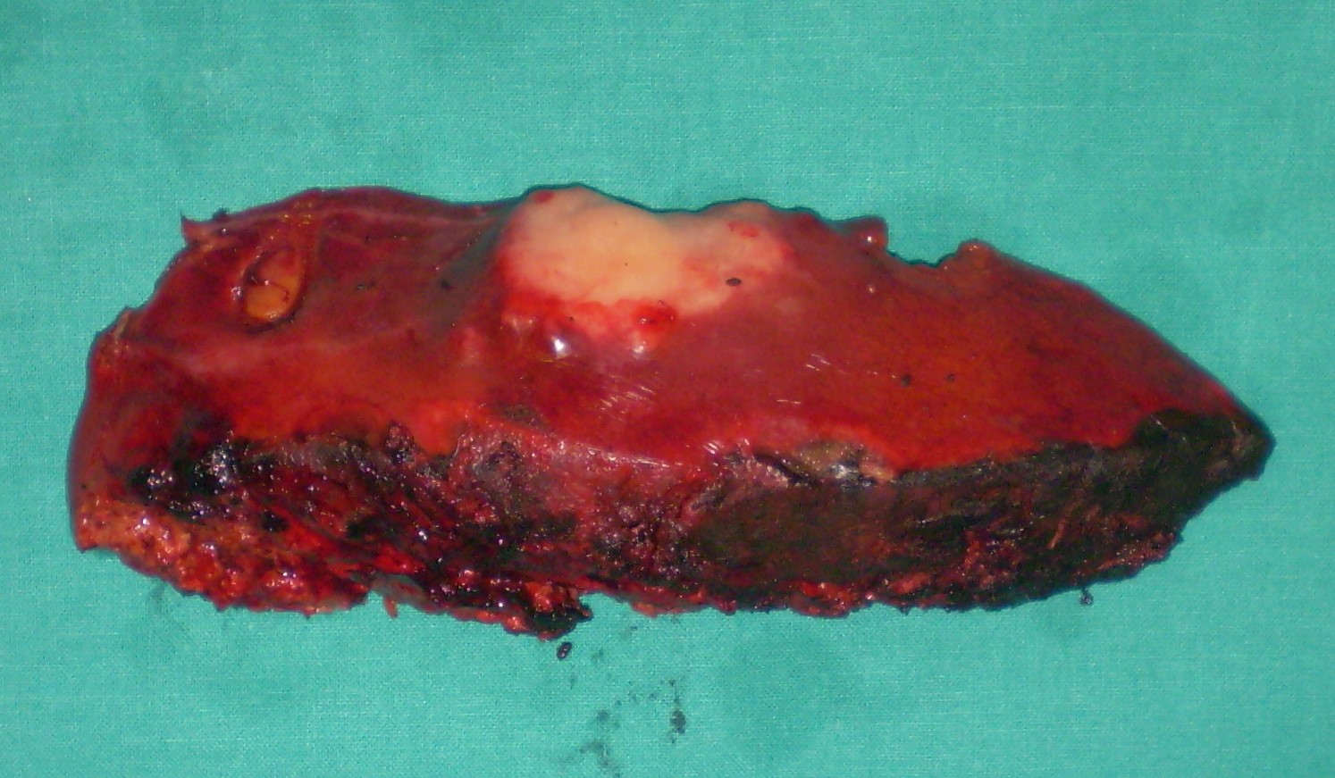 EXCISION METASTATIC LESION