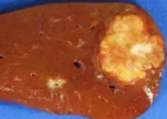 FIBROLAMELLAR CARCINOMA