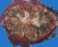 FIBROLAMELLAR CARCINOMA 
