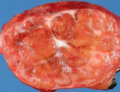 FOCAL NODULAR HYPERPLASIA