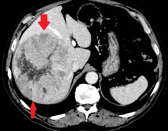 FOCAL NODULAR HYPERPLASIA 