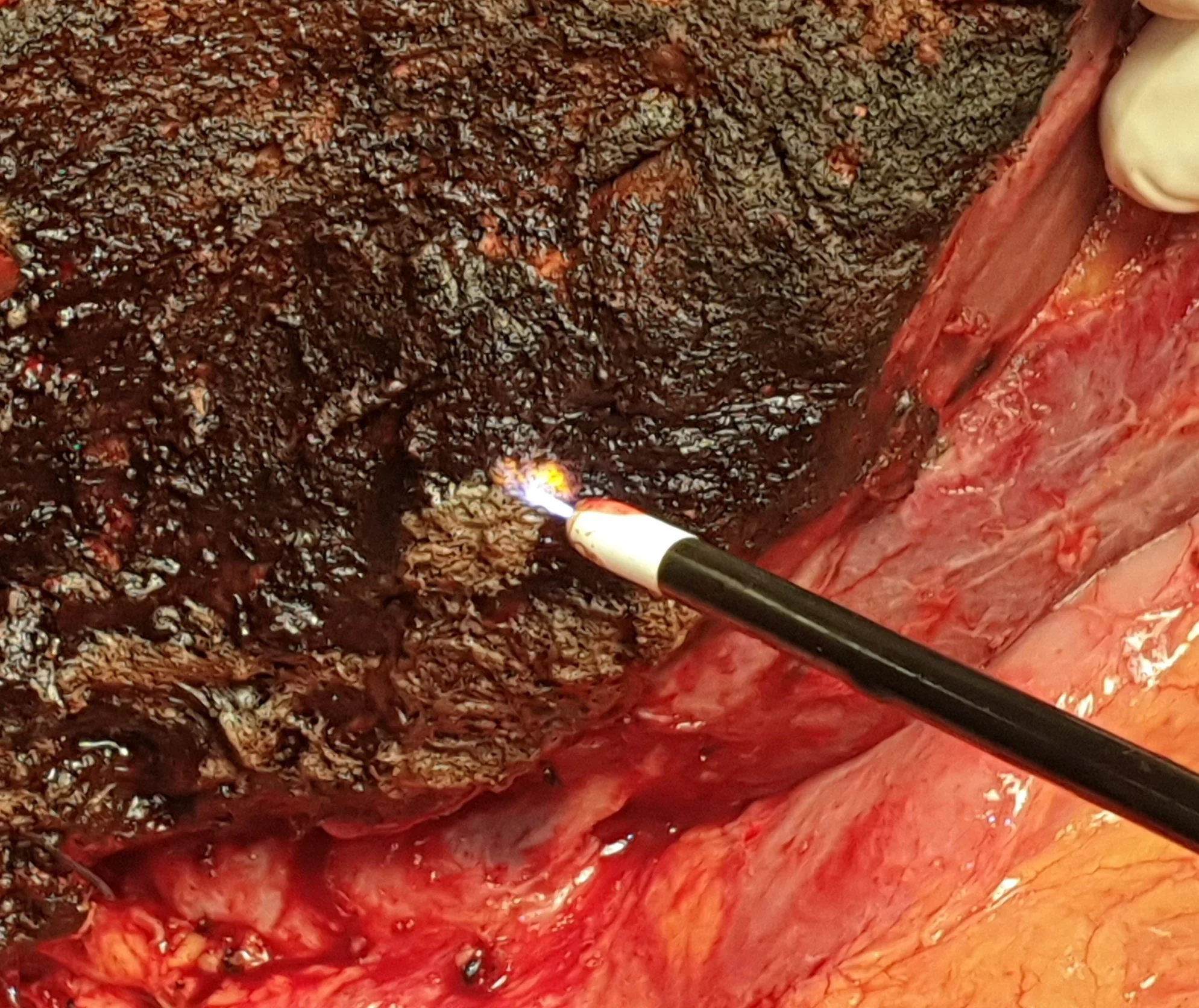 ARGON PLASMA COAGULATION