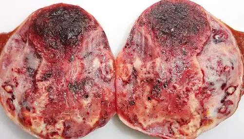 HEMANGIOENDOTHELIOMA