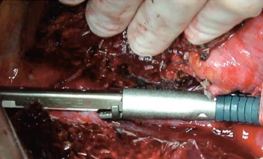 RIGHT HEPATIC VEIN LIGATION WITH ENDO-GIA