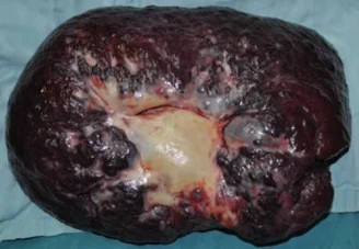 HEPATIC HAEMANGIOMA