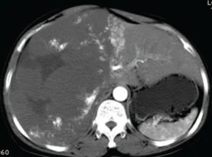 HEPATIC HAEMANGIOMA