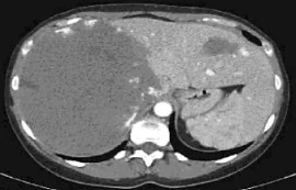 HEPATIC HAEMANGIOMA