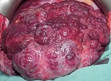 HEPATIC HAEMANGIOMA