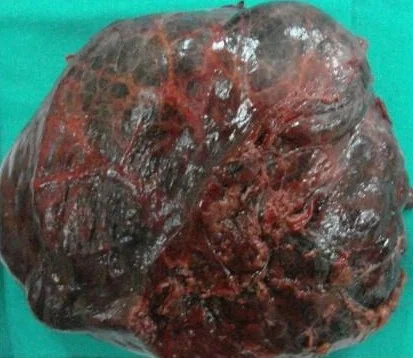 HEPATIC HAEMANGIOMA