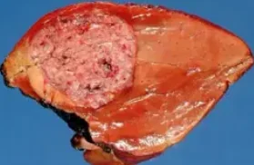 HEPATOBLASTOMA
