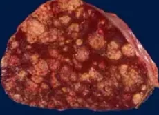 HEPATOCELLULAR CARCINOMA