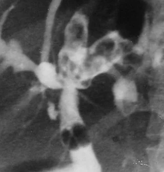 HEPATOLITHIASIS