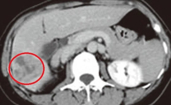 HEPATOLITHIASIS - PRIMARY SQUAMOUS CARCINOMA
