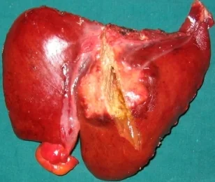 LIVER HΕPATOMA