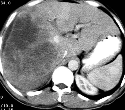 LIVER HEPATOMA