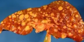 HODGKIN'S LYMPOMA