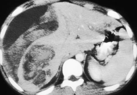 INTRAHEPATIC HAEMATOMA