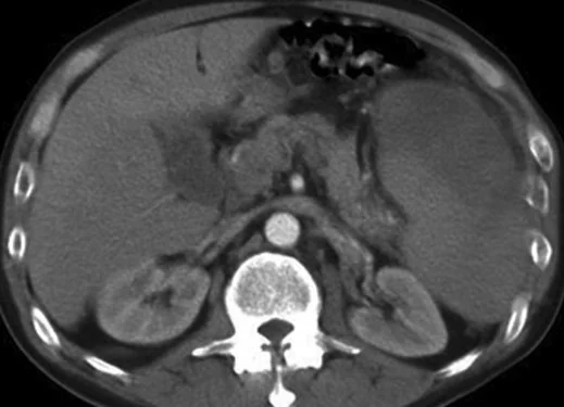 LIVER - SPLEEN INFARCTS