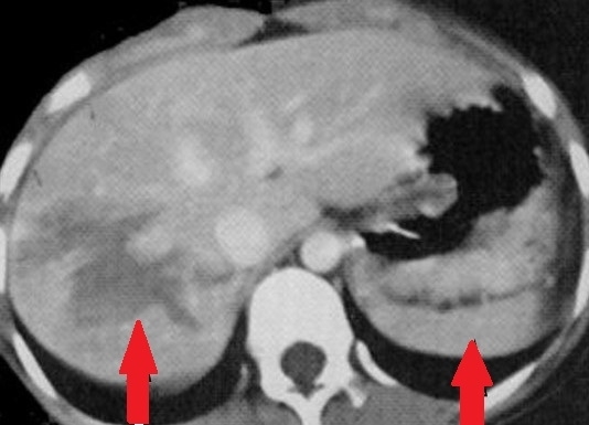 LIVER - SPLENIC INJURIES