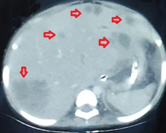 LIVER ABSCESSES