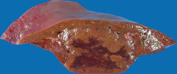 LIVER ADENOMA