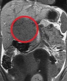 LIVER ADENOMA