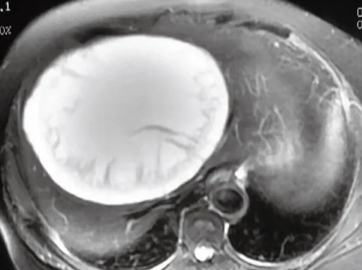 SIMPLE LIVER CYST