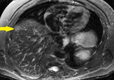 LIVER GASTRINOMA