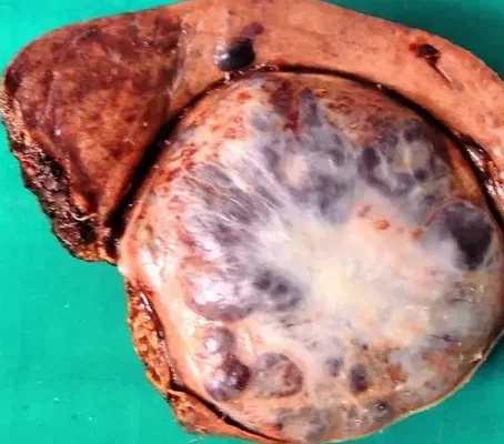 LIVER HEMANGIOMA 