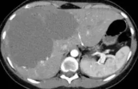 LIVER HEMANGIOMA 