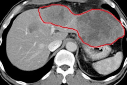 LIVER LEIOMYOSARCOMA